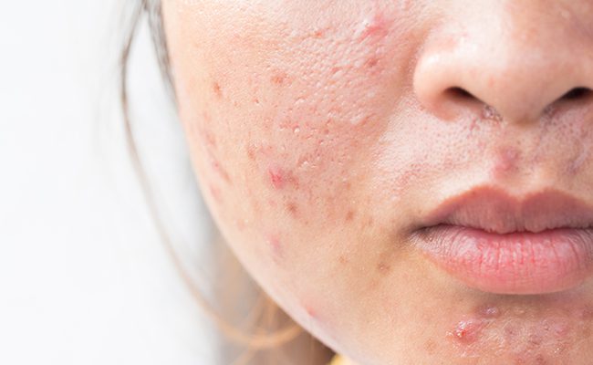 teen with acne