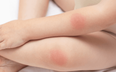 Should I be Worried about a Rash? When to Call Your Doctor