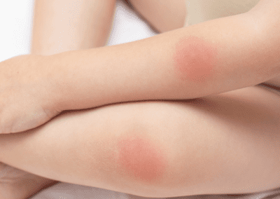 Should I be Worried about a Rash? When to Call Your Doctor